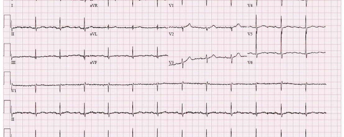ECG 64-jarige vrouw bij hypertensie